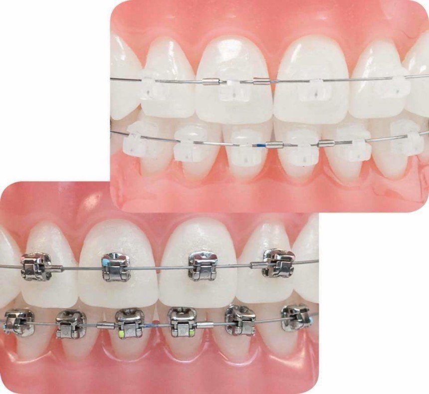 Orthodontic / Braces Treatment