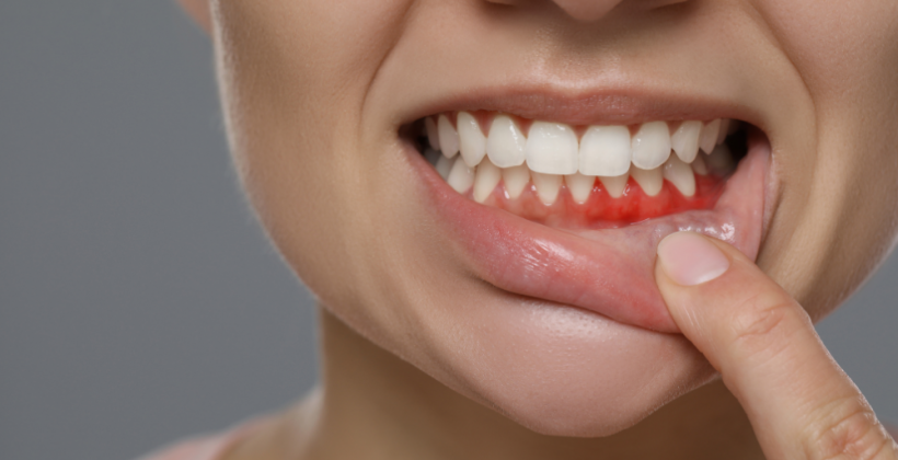 What Does a Periodontist Do for Receding Gums? What Does a Periodontist Do for Receding Gums?