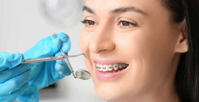 How Long Do Braces Take to Straighten Teeth? How Long Do Braces Take to Straighten Teeth?