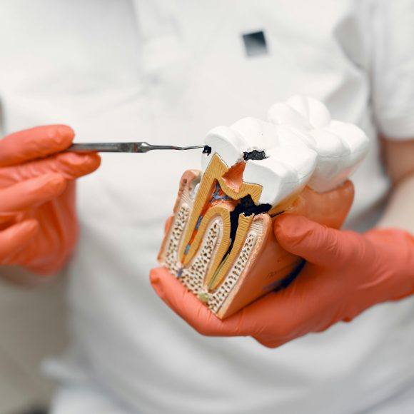 What Is Root Canal Treatment and When Do You Need It?