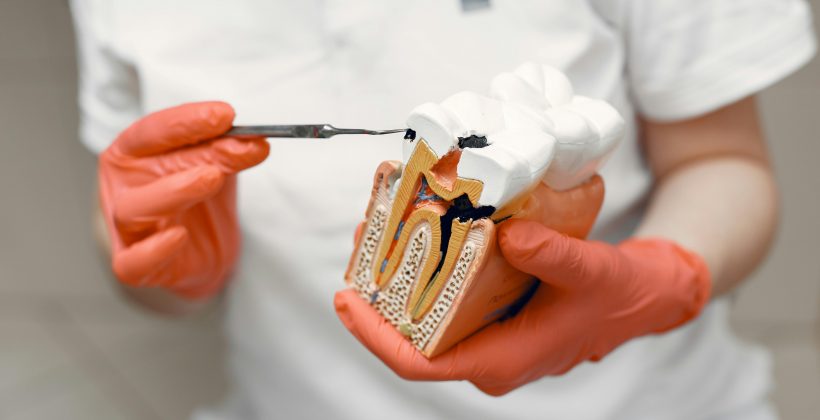 What Is Root Canal Treatment and When Do You Need It?