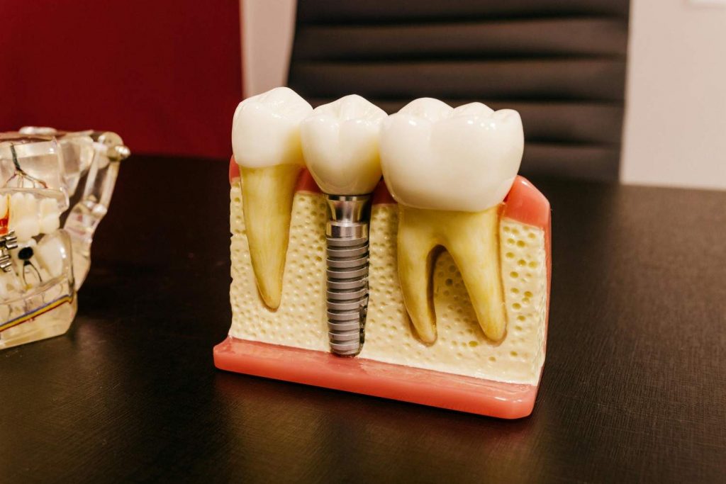 A model of a dental implant on a table