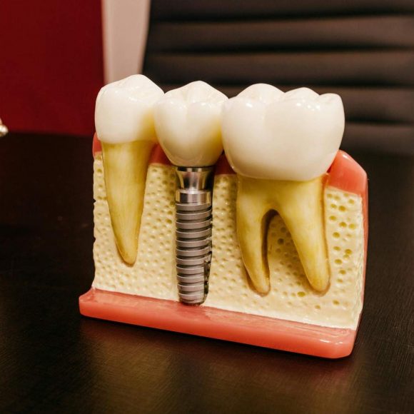 How Much Do Dental Implants Cost in Abu Dhabi?