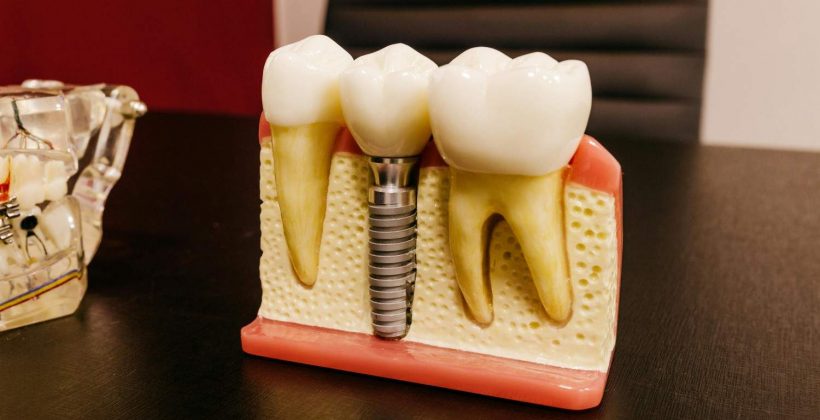How Much Do Dental Implants Cost in Abu Dhabi?